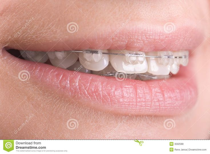 Best of Braces facial comp