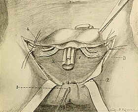 penectomy fiction midget naked penectomy fiction
